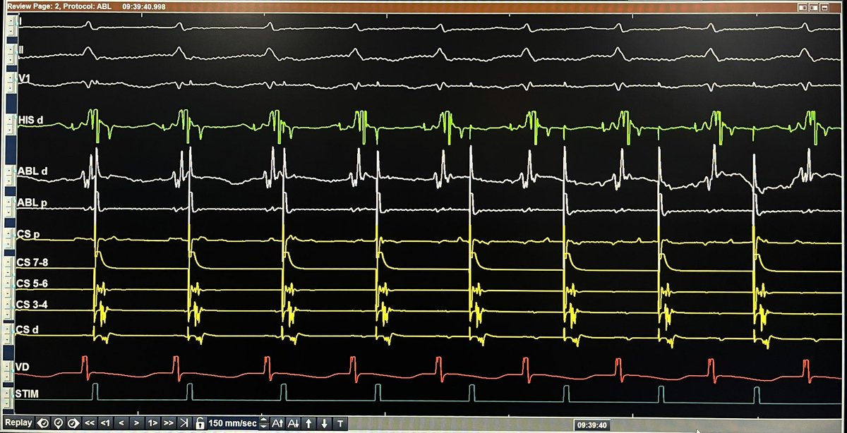 29 yof 
PMHx of documented SVT c/w AVNRT not Inducible in the lab. 2nd case in a row.

RFA performed during SR&gt;RR phenomenon.

“Inverted AVN Wenckebach sign” 

This is due to successful RFA of slow pathway of AVN

Done with <a href="/KamilaOlivera13/">Kamila Olivera</a> &amp; <a href="/GusCostaEP57/">Gustavo Costa</a> 

<a href="/hospitalposadas/">Hospital Posadas</a>