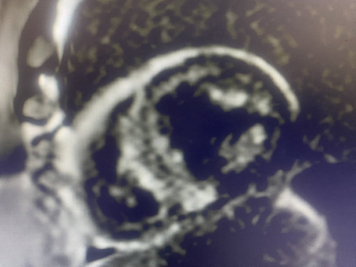 73yo male. Recent onset of HF. Reverse nulling pattern/transmural LGE. Advanced Amyloidosis