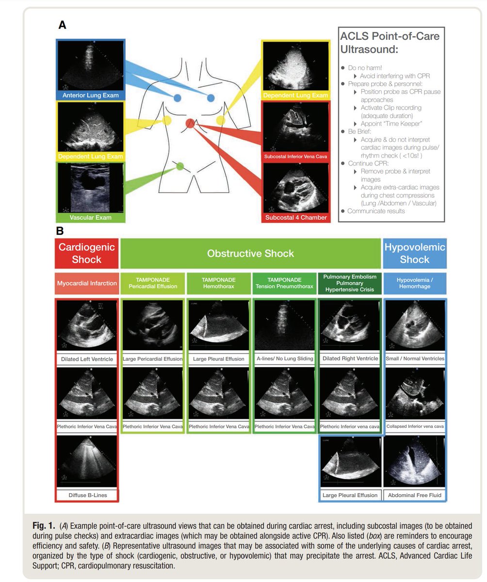 zbitarsonoicu's tweet photo. Point-of-care Ultrasound in Cardiac Arrest
Point-of-care ultrasound is a valuable tool for confirming rhythm classification, detecting preserved cardiac activity, 

Anesthesiology 135(3):p 508-519, September 2021. | DOI: 10.1097/ALN.0000000000003811 https://t.co/87vtrYR0om