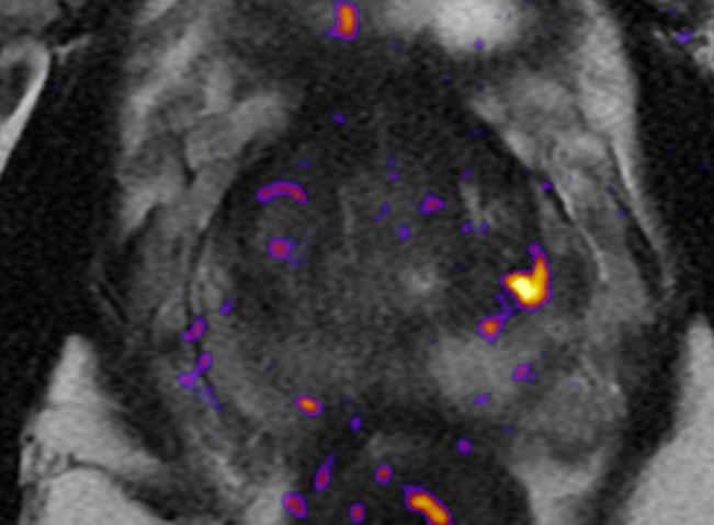 Matt Cooperberg (@dr_coops) on Twitter photo First HIFU case <a href="/UCSFCancer/">UCSF Helen Diller Family Comprehensive Cancer Ctr</a> to be guided by new restricted spectrum imaging MRI sequence! Very cool images :)
Many thanks <a href="/SeanWoolenMD/">Sean Woolen MD MS</a> <a href="/Cortechs_ai/">Cortechs.ai</a> <a href="/haognguyen/">Hao Nguyen</a> <a href="/FocalOneHIFU/">Focal One</a> for helping make it happen, and to <a href="/TylerSbrt/">Tyler Seibert MD PhD</a> and <a href="/lissmike/">Michael Liss</a> for leading the charge on this tech. First HIFU case <a href="/UCSFCancer/">UCSF Helen Diller Family Comprehensive Cancer Ctr</a> to be guided by new restricted spectrum imaging MRI sequence! Very cool images :)
Many thanks <a href="/SeanWoolenMD/">Sean Woolen MD MS</a> <a href="/Cortechs_ai/">Cortechs.ai</a> <a href="/haognguyen/">Hao Nguyen</a> <a href="/FocalOneHIFU/">Focal One</a> for helping make it happen, and to <a href="/TylerSbrt/">Tyler Seibert MD PhD</a> and <a href="/lissmike/">Michael Liss</a> for leading the charge on this tech.