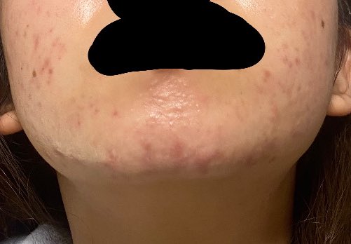 こりゃ長期戦だわ
だいぶできずらくはなったけど去年の5月頃からニキビ0の日がない