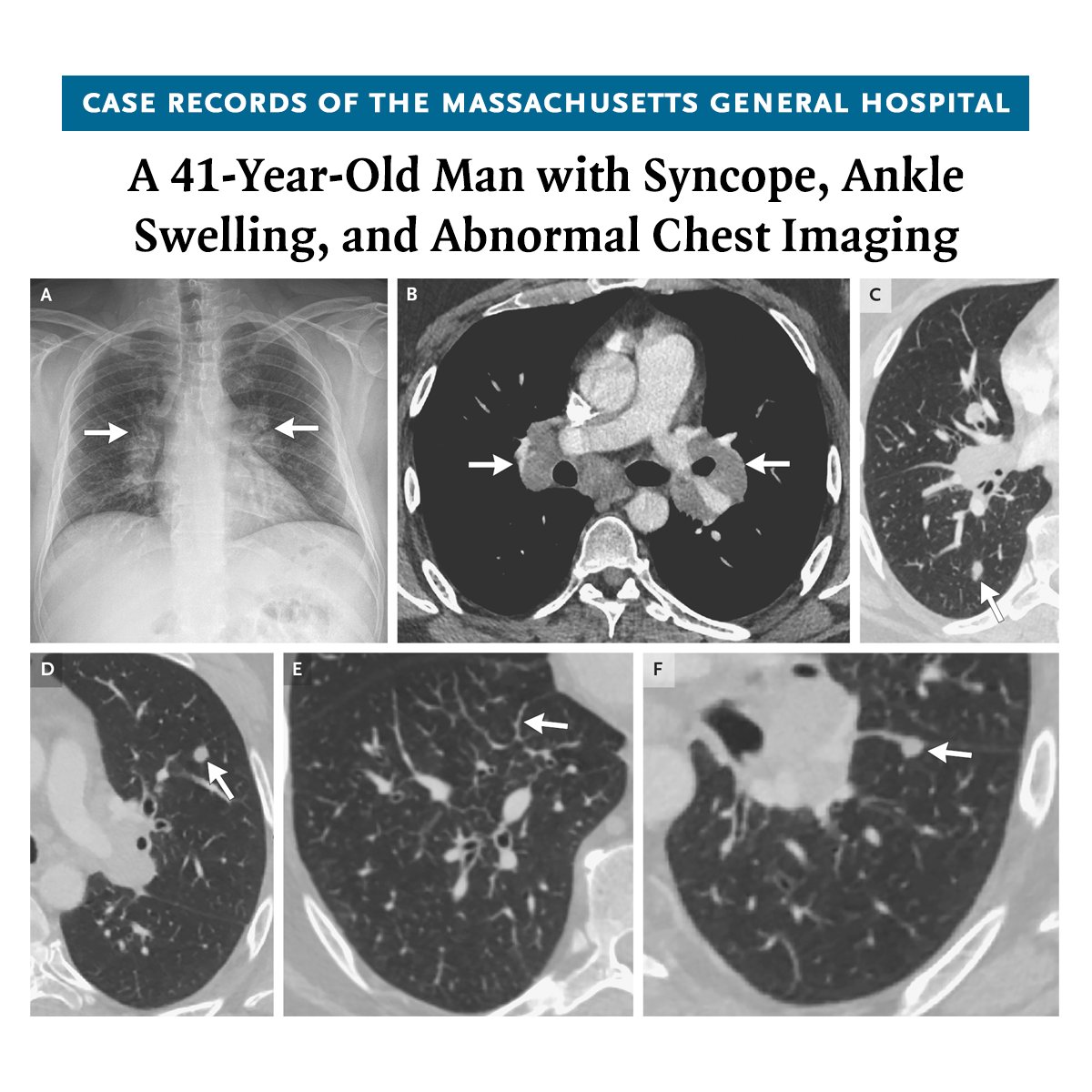 NEJM (@nejm) on Twitter photo Case Record of the MGH (<a href="/MassGeneralNews/">MassGeneral News</a>): A 41-year-old man was evaluated for swelling in the ankles and syncope. CT of the chest showed bilateral mediastinal and hilar lymphadenopathy, as well as an 8-mm nodule in the right lower lobe. A diagnosis was made. Read the full case Case Record of the MGH (<a href="/MassGeneralNews/">MassGeneral News</a>): A 41-year-old man was evaluated for swelling in the ankles and syncope. CT of the chest showed bilateral mediastinal and hilar lymphadenopathy, as well as an 8-mm nodule in the right lower lobe. A diagnosis was made. Read the full case