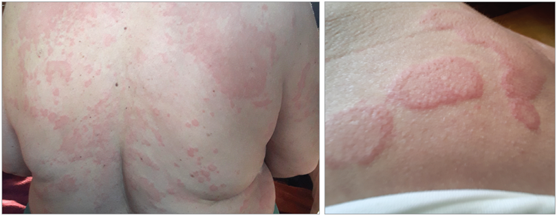 Aller_MD's tweet photo. JAMA Clinical Challenge: A 58-year-old woman with no history of #allergies or #rheumatic #disease presented to the #allergy clinic with a 2-year history of #spontaneous #wheals that occurred daily, accompanied by #pruritus and a #burning sensation. https://t.co/2mH92WhQh2 https://t.co/TPJye8oibK