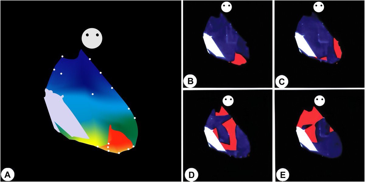 Iconic Figure: My journey with the CARTO system, by Shlomo Ben-Haim, MD, DSc 
heartrhythmjournal.com/article/S1547-…