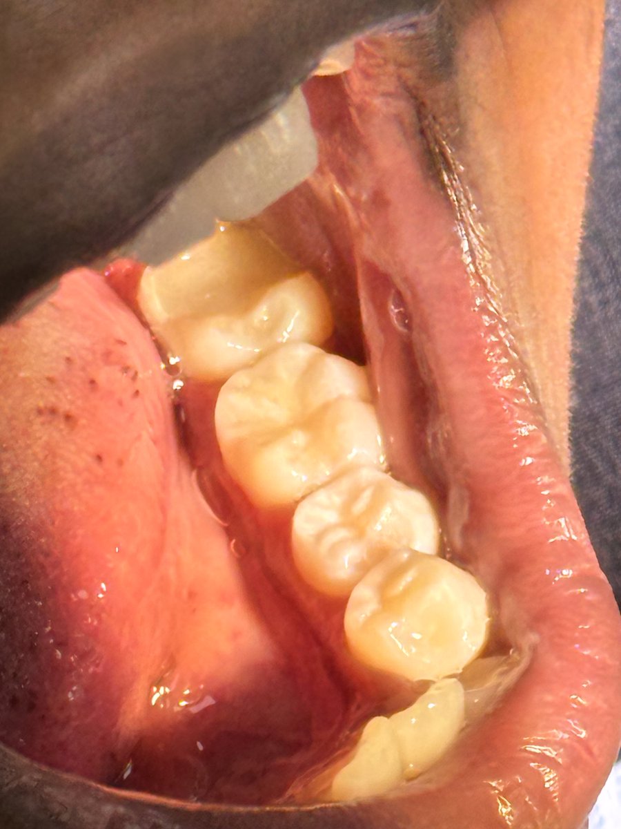 What perfection looks like

Class I restoration on #36 and #35