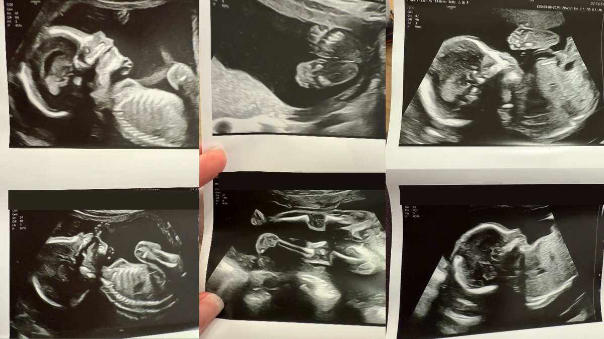 maggielove_'s tweet image. In December, I had my 20-week full anatomy scan.

@jonwu_ held my hand tightly while the technician squeezed jelly over my belly. As she performed the ultrasound, we looked at Baby Love Wu on a big screen.

There everything was. A brain. A spine. Kidneys. Fingers. Two little…