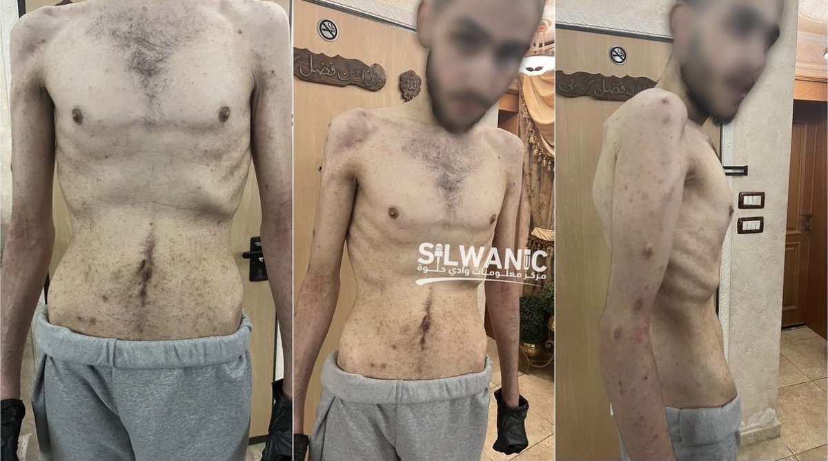 EyeonPalestine's tweet image. This is what the body of prisoner Mohammad Al-Sabah looks like after being afflicted with “Scabies,” a skin disease that has affected prisoners in the jails due to deliberate neglect of hygiene by the prison authorities.