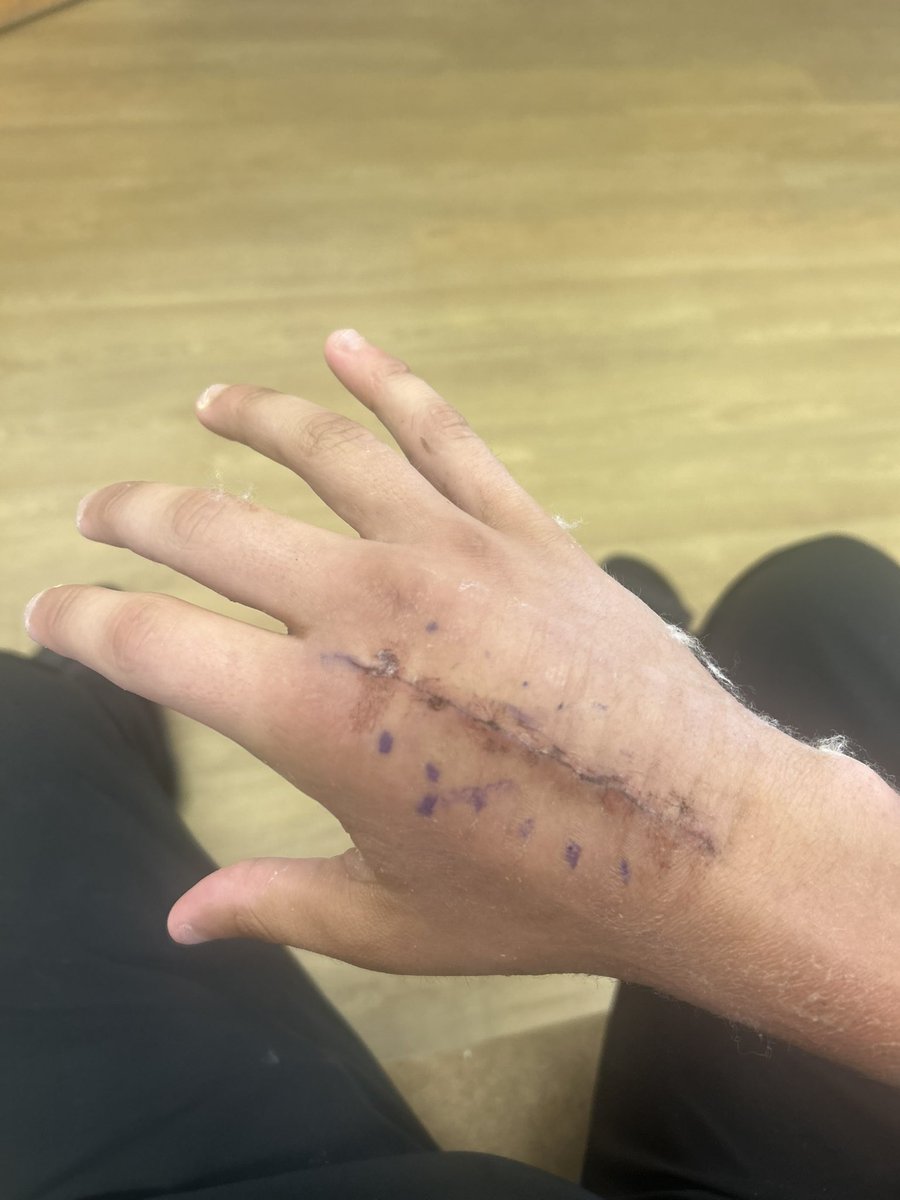 Bray2025's tweet photo. AGTG! Finally 💯 cleared by the doctor, I played the majority of the year with a torn right labrum in my shoulder and a fractured right hand that required surgery. I missed only 3 games out of 16 at ILB while playing with a club cast. My brothers and I earned the ultimate goal with our blood, sweat, and tears! 🏆💍 #StateChamps