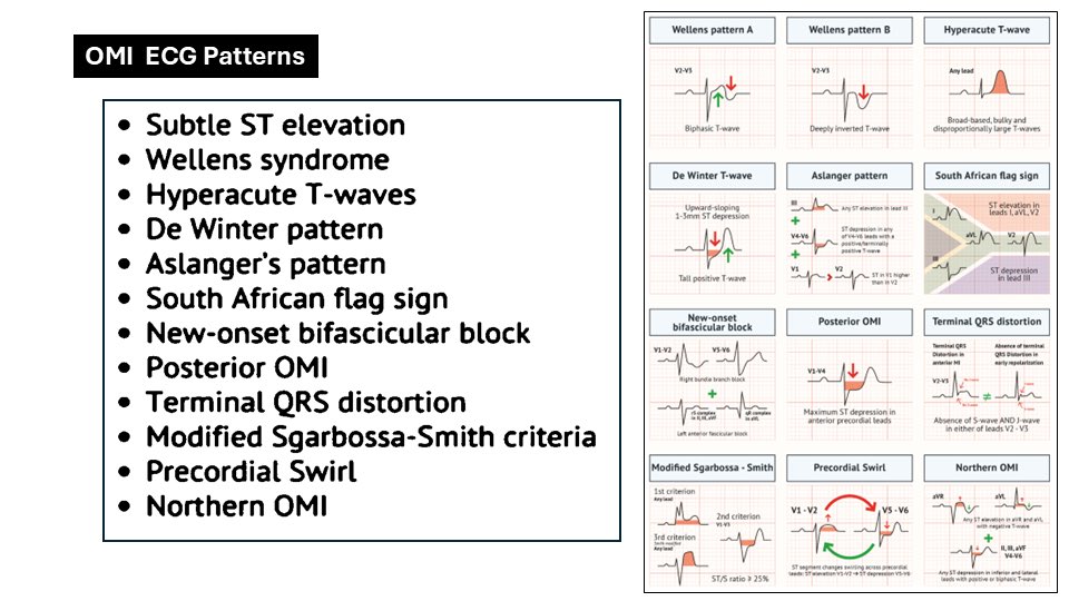 jackcfchong's tweet photo. OMI ECG Patterns
https://t.co/NtxGEGxAwH
Occlusion Myocardial Infarction (OMI) refers to an acute coronary occlusion or near occlusion with insufficient collateral circulation, leading to myocardial infarction. Unlike STEMI, OMI is not solely defined by ECG patterns but involves clinical assessment, biomarkers, and angiography.
The OMI paradigm is preferred over STEMI for several reasons:
• Improved Diagnosis: OMI can identify occlusions even without typical STEMI ECG changes, reducing missed diagnoses and delays in treatment.
• Clinical Relevance: OMI focuses on the pathophysiological substrate (coronary occlusion) rather than just ECG signs, allowing for more accurate and timely interventions.
• Outcomes: Patients with STEMI(-) OMI have similar adverse outcomes to STEMI(+) OMI but experience delays in catheterization, highlighting the need for a more inclusive approach.