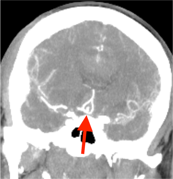 meGursesmd's tweet photo. Today's case! We successfully treated a patient brought to the emergency department with a ruptured anterior communicating artery aneurysm through surgical clipping. #neurosurgery #neuroanatomy #BrainAneurysm #aneurysm #Microneurosurgery #brain #surgery #skullbase #Medicine https://t.co/y6b2rpXQhg