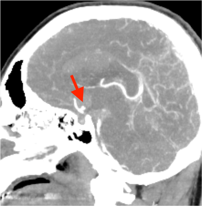 meGursesmd's tweet photo. Today's case! We successfully treated a patient brought to the emergency department with a ruptured anterior communicating artery aneurysm through surgical clipping. #neurosurgery #neuroanatomy #BrainAneurysm #aneurysm #Microneurosurgery #brain #surgery #skullbase #Medicine https://t.co/y6b2rpXQhg