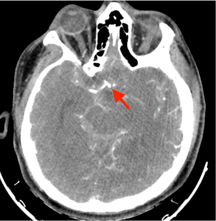 meGursesmd's tweet photo. Today's case! We successfully treated a patient brought to the emergency department with a ruptured anterior communicating artery aneurysm through surgical clipping. #neurosurgery #neuroanatomy #BrainAneurysm #aneurysm #Microneurosurgery #brain #surgery #skullbase #Medicine https://t.co/y6b2rpXQhg