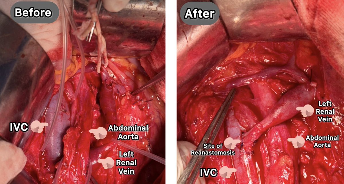 M_Khfagey2016's tweet photo. Proud to participate in such a rare &amp; challenging vascular case
Posterior type Nut Cracker syndrome (compressed Lt Renal vein between the Aorta &amp; Vertebrae)
Repaired by Lt Renal Vein transposition above the Aorta
By Dr Ihab Nabil &amp; Vascular surgery team at Nasser institute https://t.co/wvlHJVzxqV