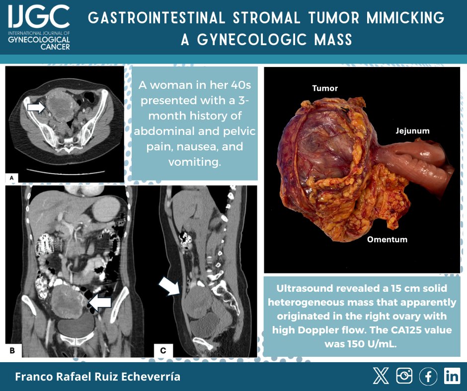 IJGC (@ijgconline) on Twitter photo #Images Gastrointestinal stromal tumor mimicking a gynecologic mass
<a href="/ginecooncolap/">Franco Ruiz</a>
📷 bit.ly/40Usa5m
<a href="/pedroramirezMD/">Pedro T Ramirez</a> <a href="/HsuMd/">Arthur_HC_Hsu</a> <a href="/JayrajAarthi/">Aarthi S Jayraj</a> <a href="/AndreFernandes2/">Andreina Fernandes</a> <a href="/IGCSociety/">IGCS</a> <a href="/ESGO_society/">ESGO</a> <a href="/ENYGO_official/">European Network of Young Gynae Oncologists</a> <a href="/OncoAlert/">OncoAlert</a> <a href="/IJGCfellows/">IJGC Fellows</a> <a href="/GynMe4/">SoMe4GynOnc</a> <a href="/thomasbartlMD/">Thomas Bartl</a> <a href="/kfischermd/">Kyra Fischer</a> #Images Gastrointestinal stromal tumor mimicking a gynecologic mass
<a href="/ginecooncolap/">Franco Ruiz</a>
📷 bit.ly/40Usa5m
<a href="/pedroramirezMD/">Pedro T Ramirez</a> <a href="/HsuMd/">Arthur_HC_Hsu</a> <a href="/JayrajAarthi/">Aarthi S Jayraj</a> <a href="/AndreFernandes2/">Andreina Fernandes</a> <a href="/IGCSociety/">IGCS</a> <a href="/ESGO_society/">ESGO</a> <a href="/ENYGO_official/">European Network of Young Gynae Oncologists</a> <a href="/OncoAlert/">OncoAlert</a> <a href="/IJGCfellows/">IJGC Fellows</a> <a href="/GynMe4/">SoMe4GynOnc</a> <a href="/thomasbartlMD/">Thomas Bartl</a> <a href="/kfischermd/">Kyra Fischer</a>