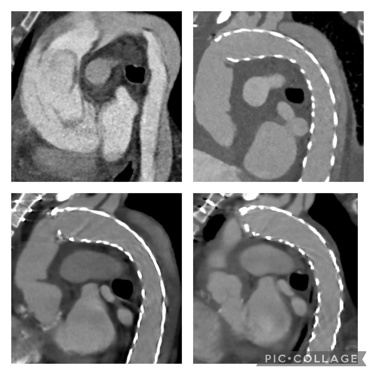 The initial case: Type A , huge AI, aortic root/ascending/ arch dissected, malperfusion, CAD, treated with Freestyle ascending replacement AMDS-Stent ,CABG X ; 1 year later we have observed an excellent result in terms of remodeling
<a href="/AWeymannMD/">Ale𝕏ander Weymann</a> 
<a href="/THINK__AORTA/">THINK AORTA Global</a> 
<a href="/ArtivionInc/">Artivion</a>