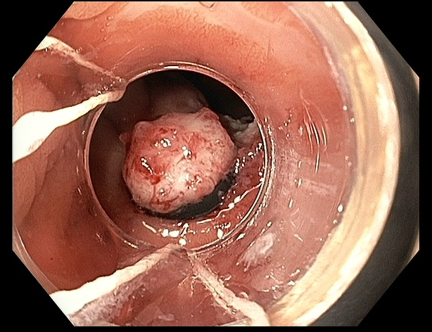 BaystateAdvEndo's tweet photo. Removal of a laterally spreading rectal tumor via band EMR and hybrid APC by 3rd year fellow Dr. Groudan and associate program director Dr. Zakharia. Advanced fellows will receive ample training in removal of large polyps by endoscopic mucosal resection, endoscopic submucosal dissection, and endoscopic full thickness resection.
