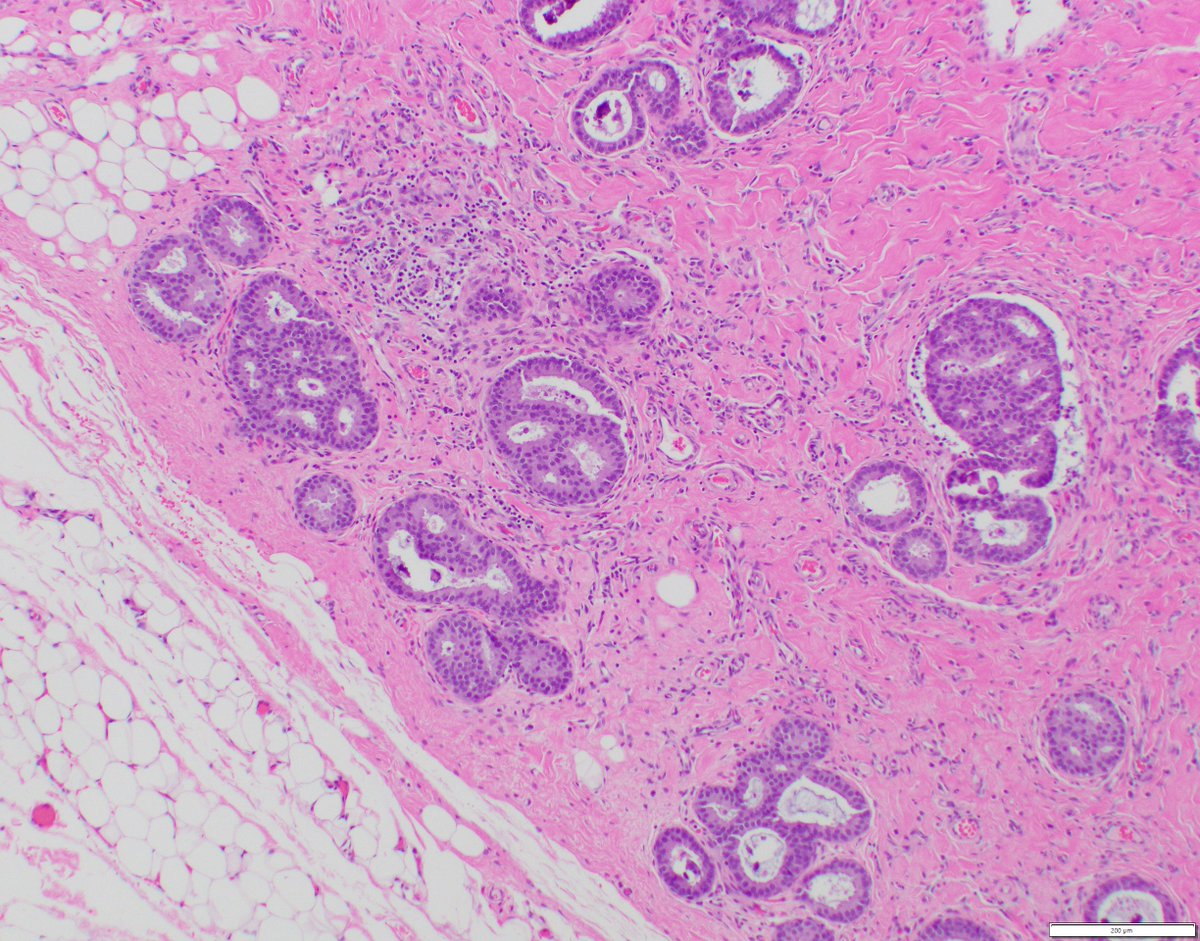 ADH involving fibroadenoma.
#breastpath #pathresidents #pathtwitter #BreastPatholog1
<a href="/ColumbiaPath/">Columbia Pathology</a> <a href="/Columbia/">Columbia University</a>pathres @Columbia
<a href="/TheISBP/">ISBP</a>