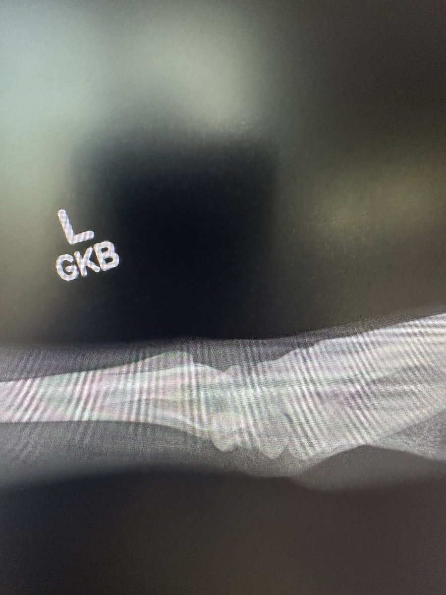 sanjkakar's tweet photo. How do you treat perilunate dislocations? Consider arthroscopic reduction &amp; stabilization without morbidity of an open approach ⁦@IWAS_Wrist⁩ ⁦@AAOS1⁩ ⁦@FESSHEurope⁩ ⁦@HandSurgeryAssn⁩ #perilunate #wrist ⁦@AANAORG⁩ https://t.co/3FTFHbJem2