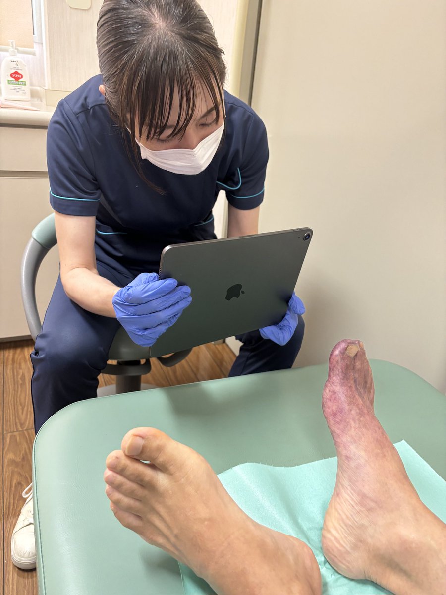 secondheart_jp's tweet image. 医療現場のDX化は、単なるデジタル化ではなく、患者の命を救う仕組みを作ること。

Steplifeは、患者の足を守るための写真と記録を同時に保存するクラウド型フットチェックアプリです。

早期発見・早期治療で足切断を防ぎ、QOLを向上させるDXを推進中！

#医療DX #Steplife #糖尿病 #フットケア