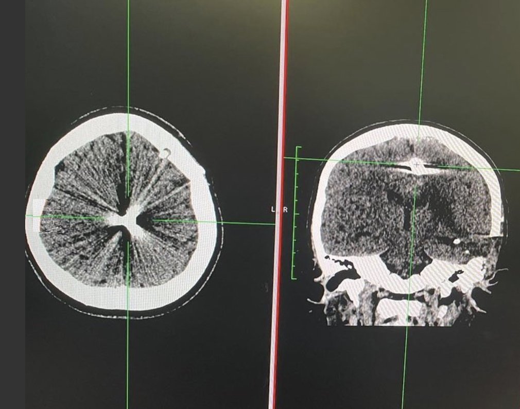 PHOTO GALLERY: Radiology images of Ukrainian trauma patients wounded in war -- healthimaging.com/topics/medical…