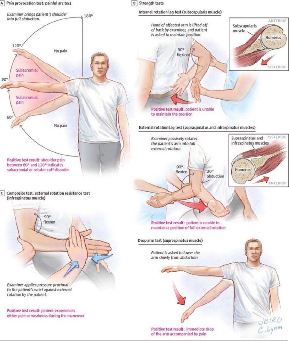 Some common clinical tests for the evaluation of "Rotator Cuff" related conditions. 

#TheArmDoc #OrthoGlobe 
pubmed.ncbi.nlm.nih.gov/2398237