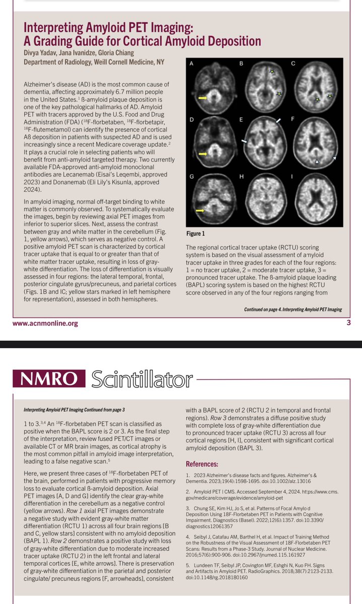 Divya Yadav MD (@idivyamd) on Twitter photo Check out our newest segment: Guide to amyloid PET interpretation published in ACNM-NMRO winter 2025 scintillator newsletter. Thanks <a href="/jana_ivanidze/">Jana Ivanidze</a> <a href="/GloriaChiangMD/">Gloria Chiang, MD</a> <a href="/TheNUCguy/">Ashwin Singh Parihar, MBBS, MD</a> <a href="/BitalSavirBMD/">Bital Savir-Baruch MD, FACNM</a> <a href="/nmroacnm/">NMRO ACNM</a> for the opportunity. Check out our newest segment: Guide to amyloid PET interpretation published in ACNM-NMRO winter 2025 scintillator newsletter. Thanks <a href="/jana_ivanidze/">Jana Ivanidze</a> <a href="/GloriaChiangMD/">Gloria Chiang, MD</a> <a href="/TheNUCguy/">Ashwin Singh Parihar, MBBS, MD</a> <a href="/BitalSavirBMD/">Bital Savir-Baruch MD, FACNM</a> <a href="/nmroacnm/">NMRO ACNM</a> for the opportunity.