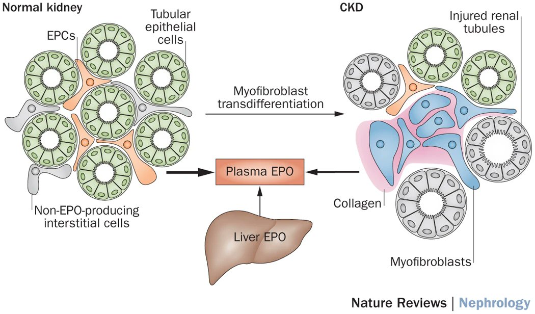 nihardesai89's tweet photo. Anemia in CKD 👇🏽

We all know that CKD = ⤵️EPO

What's the mechanism?

The interstitial cells transdifferentiate into MYOFIBROBLASTS instead of EPO producing cells

⤵️ EPO producing cells = ⤵️EPO = Anemia

#MedTwitter https://t.co/Je8DY47a4h