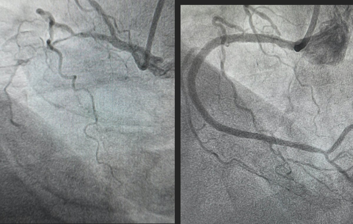 RicardioGP's tweet photo. Angina+High ischemia burden in strest echo.RC #CTO with some microchannels in AngioCT (not so visible in cathlab).AWE with Fielder XT-R and Turnpike Lp, success true-true lumen but micro didn't cross.Predil with 🎈0.75 and 1.0 the prox cap, after that the case was straightforward https://t.co/RIoqSsuwdE