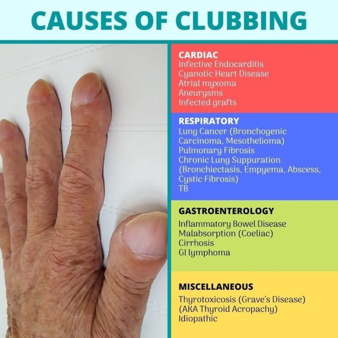 MedInsightMD's tweet photo. CAUSES OF CLUBBING.. https://t.co/ZEL8KYseof