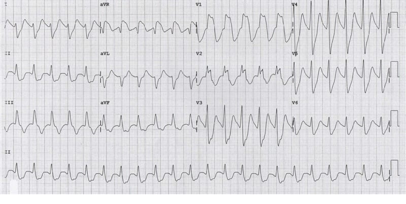 LITFL (@litflblog) on Twitter photo Seizures, coma, and a dire ECG in an 18-year-old. Dive into a medical detective story where every beat tells a tale of toxicity. litfl.com/seizures-somno…
#FOAMed #MedEd #MedTwitter #CardioTwitter Seizures, coma, and a dire ECG in an 18-year-old. Dive into a medical detective story where every beat tells a tale of toxicity. litfl.com/seizures-somno…
#FOAMed #MedEd #MedTwitter #CardioTwitter