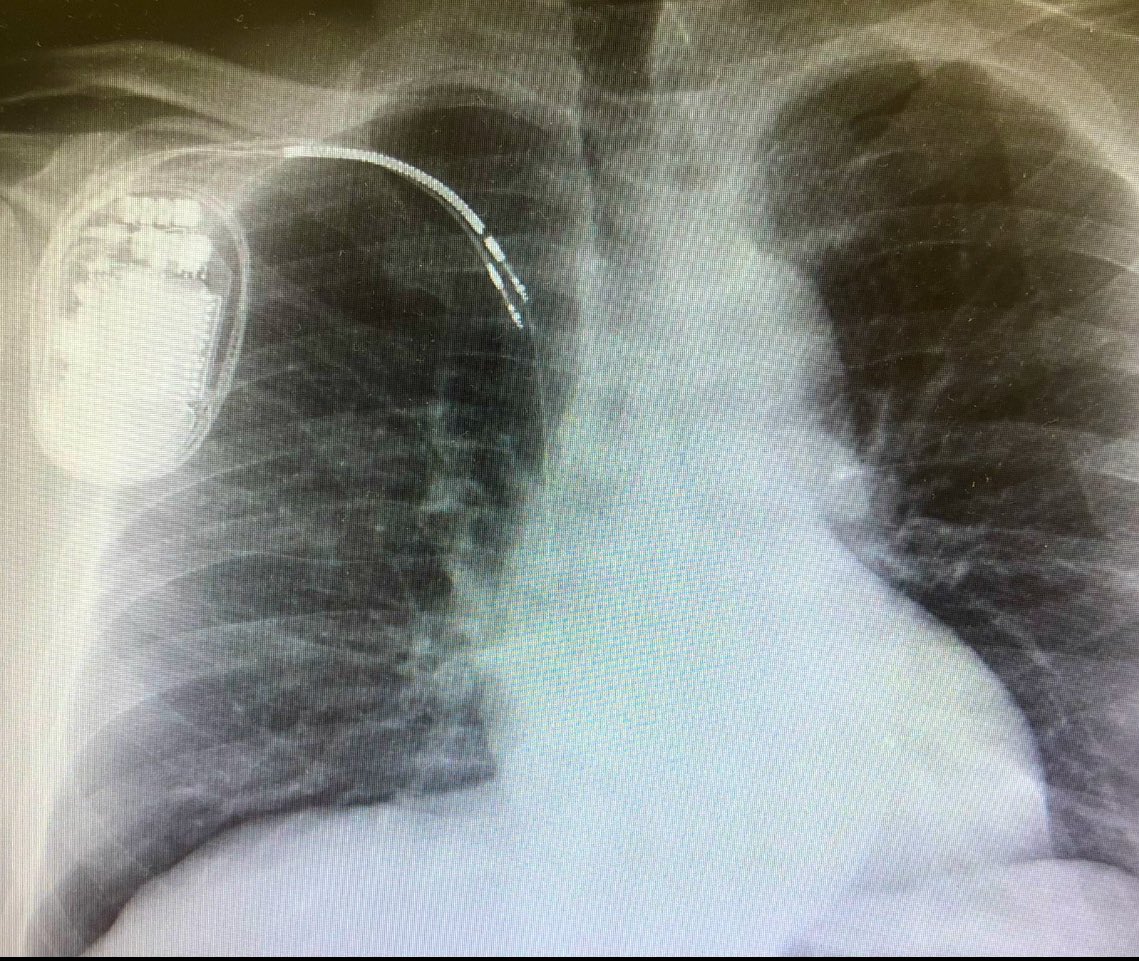 Marco Bergonti (@mbergonti) on Twitter photo The <a href="/escardio/">European Society of Cardiology</a> #EHRA Advanced CIED Course is approaching.
📍Geneva🇨🇭
📅 6-8th February 2025
Register now 👉bit.ly/3YYkdd7.
‼️Only few spots are still available‼️
<a href="/HaranBurri/">Haran Burri</a> <a href="/Marek_Jastrz_EP/">Marek Jastrzębski</a> <a href="/OCanoPerez/">Óscar Cano</a> The <a href="/escardio/">European Society of Cardiology</a> #EHRA Advanced CIED Course is approaching.
📍Geneva🇨🇭
📅 6-8th February 2025
Register now 👉bit.ly/3YYkdd7.
‼️Only few spots are still available‼️
<a href="/HaranBurri/">Haran Burri</a> <a href="/Marek_Jastrz_EP/">Marek Jastrzębski</a> <a href="/OCanoPerez/">Óscar Cano</a>
