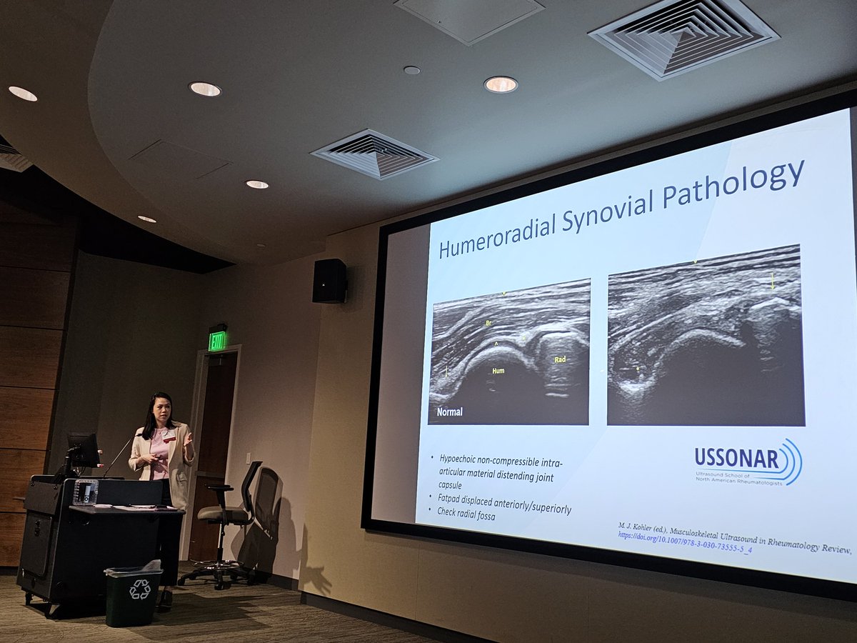 Dr. Erin Chew from <a href="/VanderbiltU/">Vanderbilt University</a> reviews elbow #sonopathology -look for #synovitis, #effusion, #gout #cppd <a href="/ErinChew11/">Erin Chew</a> #RA #PsA #SpA #rheumatology #meded
