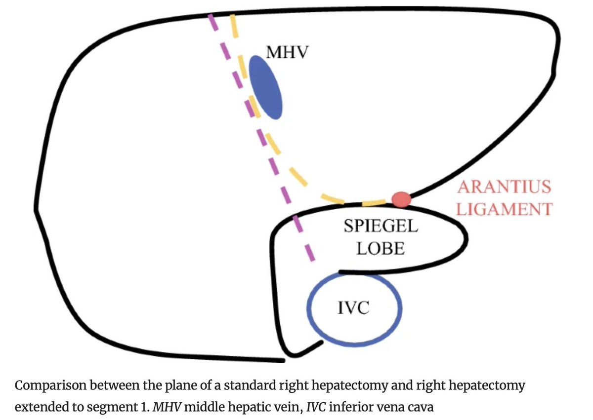 Annals of Surgical Oncology (@annsurgoncol) on Twitter photo January Issue: How to Find Correct Transection Plane in Laparoscopic Right #Hepatectomy Extended to S1 for Bismuth IIIa Perihilar #Cholangiocarcinoma <a href="/Laiafv/">Laia Falgueras</a>
rdcu.be/d73EA
<a href="/_BrainyMD_/">Micah J. Brainerd, M.D.</a>
<a href="/SyedAAhmad5/">Syed A. Ahmad</a> January Issue: How to Find Correct Transection Plane in Laparoscopic Right #Hepatectomy Extended to S1 for Bismuth IIIa Perihilar #Cholangiocarcinoma <a href="/Laiafv/">Laia Falgueras</a>
rdcu.be/d73EA
<a href="/_BrainyMD_/">Micah J. Brainerd, M.D.</a>
<a href="/SyedAAhmad5/">Syed A. Ahmad</a>