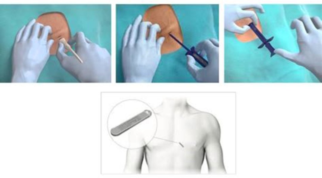 💉 ENFERMERÍA 🫀⚡ ESPECIALIZADA EN ARRITMIAS

✌🏼Nosotros creemos en la alta especialización de #enfermería para afrontar en #equipo los nuevos retos que se vienen

😎 Aquí Patricia Calderín y Rubén Andrades tras sus implantes de Holter subcutáneo en 🏥 Hosp de Día de🫀

#ubuntu
