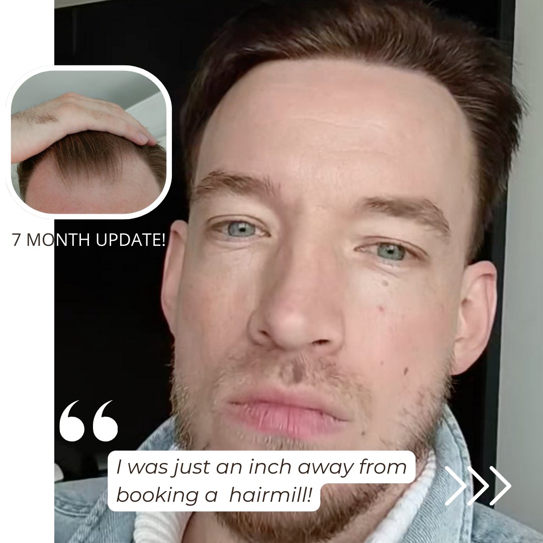 BHRClinic's tweet photo. 💯 Inches Away from a Hair Mill… and Found BHR CLINIC! 🚀

Check out this patient’s 7-MONTH UPDATE 📸🎥—and trust us, the best is yet to come! VIDEO COMING SOON! #hairtransplant #hairtransplantation #hairloss #hairline #DrBisang #DrAbby #DrKostis https://t.co/nl01bYSfpj