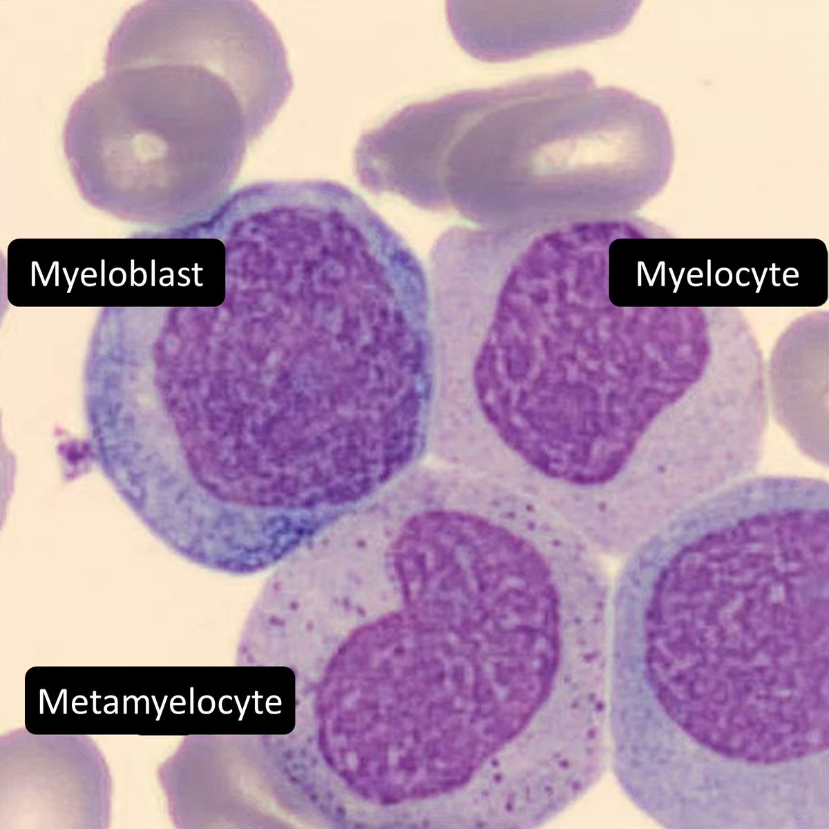 Master myeloid maturation with this newer module I made!↘️↘️↘️↘️
classmarker.com/online-test/st…
#HemePath #Hematology #pathology #PathTwitter