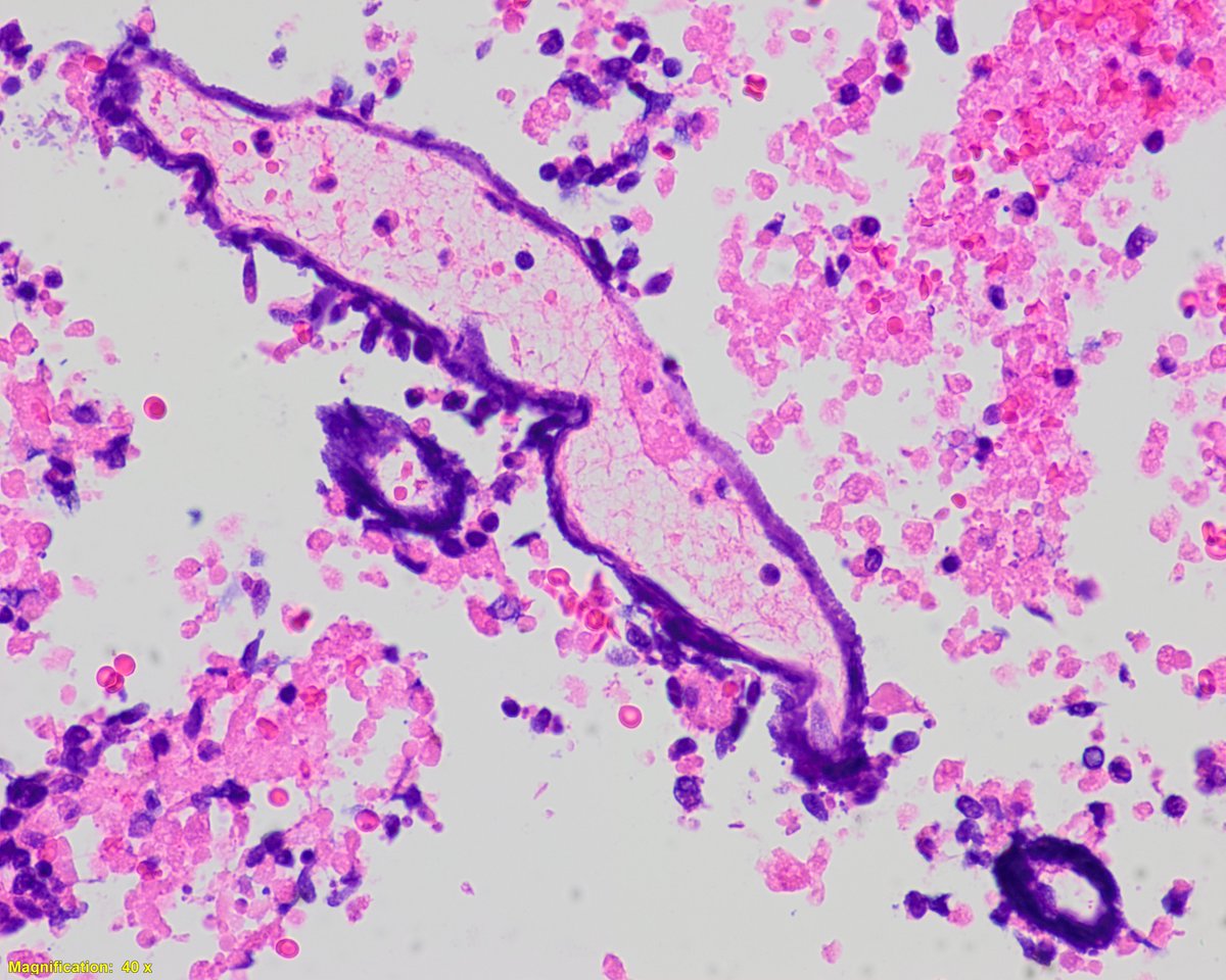 Pepe Jiménez Heffernan (@pepeheffernan) on Twitter photo CC351. A ver simple one. We just want a diagnosis
<a href="/kriyer68/">Kalyani Bambal</a> <a href="/DrBMcGinn/">Barry McGinn</a> <a href="/gonzadetoro/">Gonzalo De Toro</a> <a href="/gcai1978/">Guoping Cai, MD</a> CC351. A ver simple one. We just want a diagnosis
<a href="/kriyer68/">Kalyani Bambal</a> <a href="/DrBMcGinn/">Barry McGinn</a> <a href="/gonzadetoro/">Gonzalo De Toro</a> <a href="/gcai1978/">Guoping Cai, MD</a>