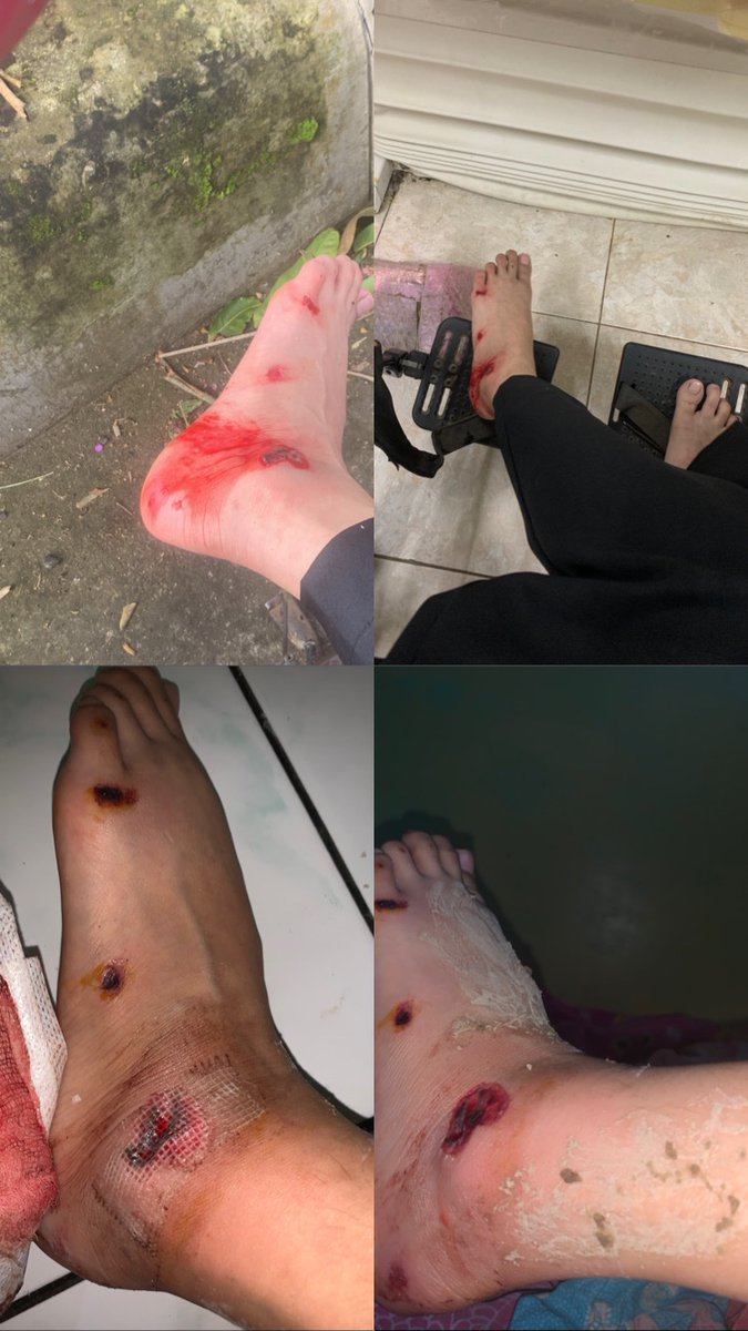 WildaNabila's tweet photo. sakit, bengkak dan kalo jalan mau nangis trs rasanya sakit bgtbgt gakuat😭 https://t.co/gNMbGwTMmn