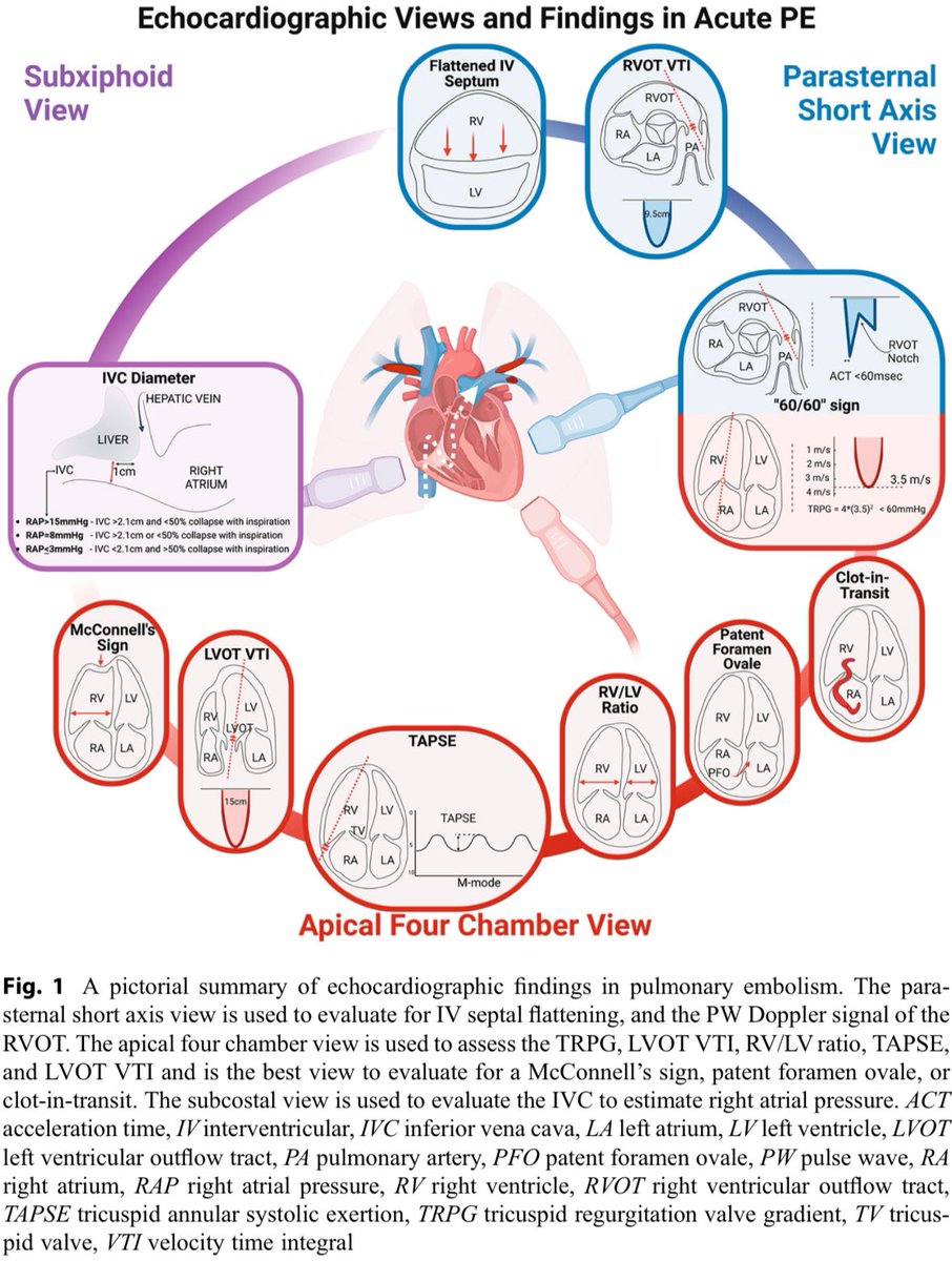 Un resumen ilustrado de los hallazgos ecocardiográficos en la embolia pulmonar:

PERT Consortium Handbook of Pulmonary Embolism 2024; DOI: doi.org/10.1007/978-3-…