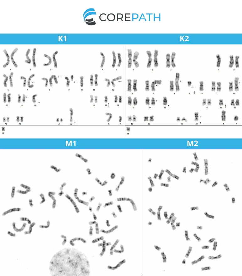 CorePath's tweet photo. Our latest Client eNewsletter is out now! View now at: 
https://t.co/qeCLeZEeuO

#TPLL #T-PLL #leukemia #cytogenetics #pathology #hemepath #bonemarrow #bonemarrowclinic #patientcare #laboratory #cancerdiagnostics #chromosomes #karyotypes #genetics #laboratory #TSP #CaringforLives https://t.co/44t1UYLBf8