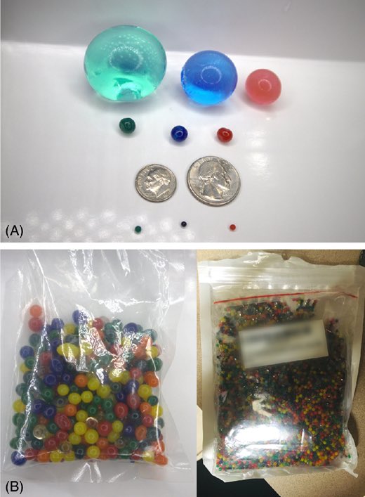Water beads, common in sensory toys, can cause bowel obstruction and neurotoxicity from acrylamide if ingested. 

#MedTwitter #GITwitter 

publications.aap.org/pediatrics/art…