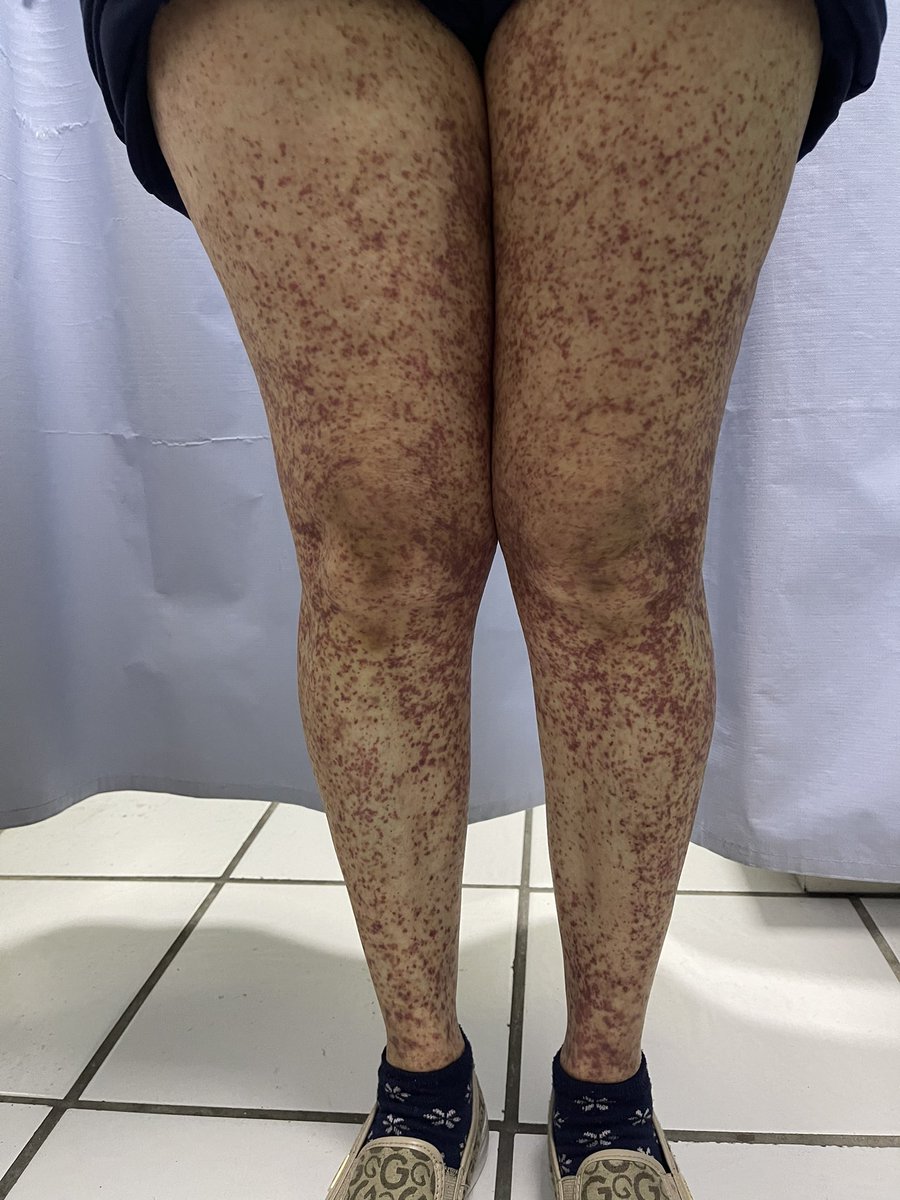fabyderma's tweet photo. La púrpura se caracteriza por manchas violáceas en piel y mucosas 
Puede ser trombocitopenica o no trombocitopenica, requiere ser diagnosticada a tiempo #dermatologa #drafabiolajimenezhernandez https://t.co/qq4CXPVvJa