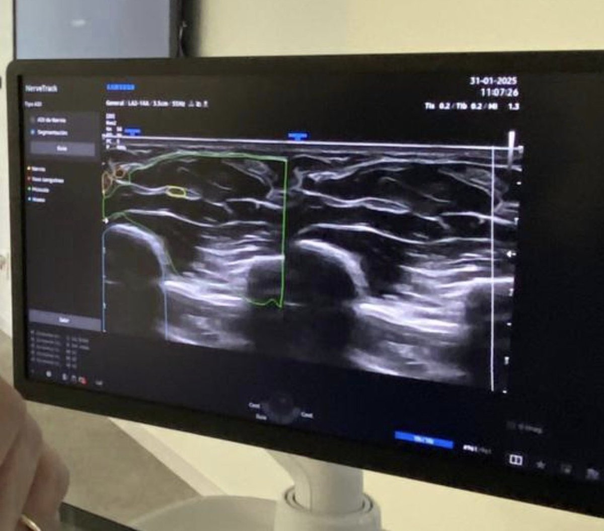 Jose Maria Palacin (@jpalacinp) on Twitter photo #Inteligenciaartificial en ecógrafos <a href="/SamsungEspana/">Samsung España</a> en nuestro curso de ECO Clínica del <a href="/COMLLEIDA/">Col·legi de Metges de Lleida</a> Detección automatizada comparativa de diferentes estructuras en #ecomusculoesqueletica <a href="/JMMR83/">Joaquín Martínez</a> <a href="/NephroP/">NephroPOCUS</a> <a href="/ABCDEcografia/">ABCDEcografía</a> <a href="/dmiguelmolina/">Dr. Miguel Molina - Ecografia Clínica - POCUS</a> <a href="/PierpaDiNick/">Pierpaolo Di Nicolò</a> <a href="/jorgezzb/">Jorge Zegarra</a> <a href="/EcosemfyC/">EcosemFYC</a> <a href="/ecoapcat/">ecoap</a> #Inteligenciaartificial en ecógrafos <a href="/SamsungEspana/">Samsung España</a> en nuestro curso de ECO Clínica del <a href="/COMLLEIDA/">Col·legi de Metges de Lleida</a> Detección automatizada comparativa de diferentes estructuras en #ecomusculoesqueletica <a href="/JMMR83/">Joaquín Martínez</a> <a href="/NephroP/">NephroPOCUS</a> <a href="/ABCDEcografia/">ABCDEcografía</a> <a href="/dmiguelmolina/">Dr. Miguel Molina - Ecografia Clínica - POCUS</a> <a href="/PierpaDiNick/">Pierpaolo Di Nicolò</a> <a href="/jorgezzb/">Jorge Zegarra</a> <a href="/EcosemfyC/">EcosemFYC</a> <a href="/ecoapcat/">ecoap</a>