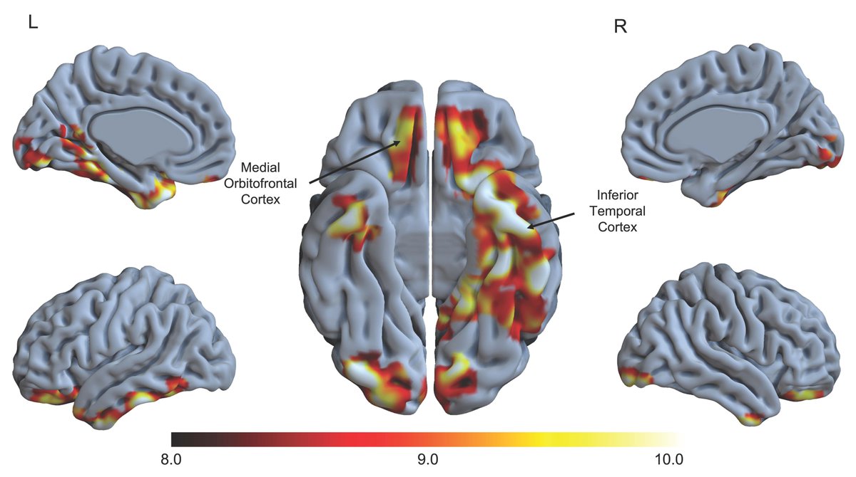 SfN Journals (@sfnjournals) on Twitter photo #JNeurosci | <a href="/CaseyVanderlip/">Casey Vanderlip</a> <a href="/jennanadams/">Jenna Adams</a> et al. found that a biomarker for #AlzheimersDisease that can precede the disease by three decades contributes to a measure of subtle memory loss, suggesting that clinical assessments probing at least this measure may be useful early #JNeurosci | <a href="/CaseyVanderlip/">Casey Vanderlip</a> <a href="/jennanadams/">Jenna Adams</a> et al. found that a biomarker for #AlzheimersDisease that can precede the disease by three decades contributes to a measure of subtle memory loss, suggesting that clinical assessments probing at least this measure may be useful early