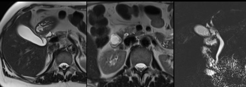 SAR DFP Benign Biliary Pathology (@sarbiliarydfp) on Twitter photo Challenge yourself with another biliary case: Courtesy of Rachita Khot, MD <a href="/RachitaKhot/">Rachita Khot</a> from <a href="/UVARadiology/">UVA Radiology</a>
61 yo female with right upper quadrant pain and jaundice. Clinically concerned for acute cholecystitis vs choledocholithiasis. MRI axial T2WI and coronal MRCP MIP images Challenge yourself with another biliary case: Courtesy of Rachita Khot, MD <a href="/RachitaKhot/">Rachita Khot</a> from <a href="/UVARadiology/">UVA Radiology</a>
61 yo female with right upper quadrant pain and jaundice. Clinically concerned for acute cholecystitis vs choledocholithiasis. MRI axial T2WI and coronal MRCP MIP images