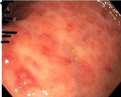 Young man with PSC/UC s/p liver txp on tacro, AZA, and infliximab. Colonoscopy for hematochezia showed acute lesions below. What are they? Tacro induced? Chronic inflammation well controlled.
#GItwitter #endoscopy #medtwitter #hepatology