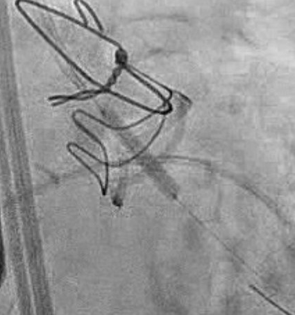 DrTGupta's tweet image. n=1 but the UNICORN procedure seems to be a game changer in leaflet modification for #TAVR with risk of coronary obstruction @HarryDauerman. Seamless and efficient. @UVMLarnerMed @Medtronic @EdwardsLifesci
Thanks to @PedroMDMSc and @kashishgoelmd for the help with planning.