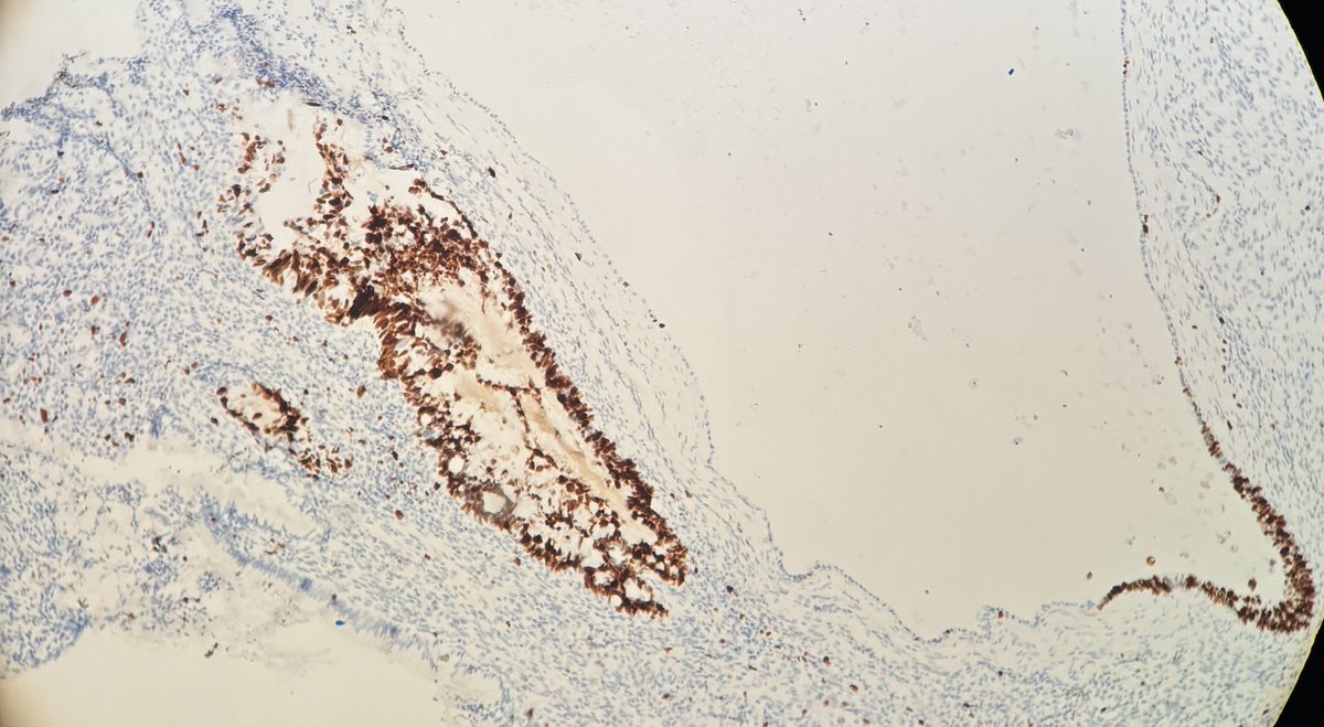 Beautiful cytohisto correlation
Endocervical adenocarcinoma in situation
Hyperchromatic crowded groups 
Rosettes
Feathering
Nuclear crowding 
Histology: 
Hyperchromatic cells , apoptosis,mucin depletion and luminal mitosis 
P16 block positivity 
Ki67 over expression
#pathtwitters