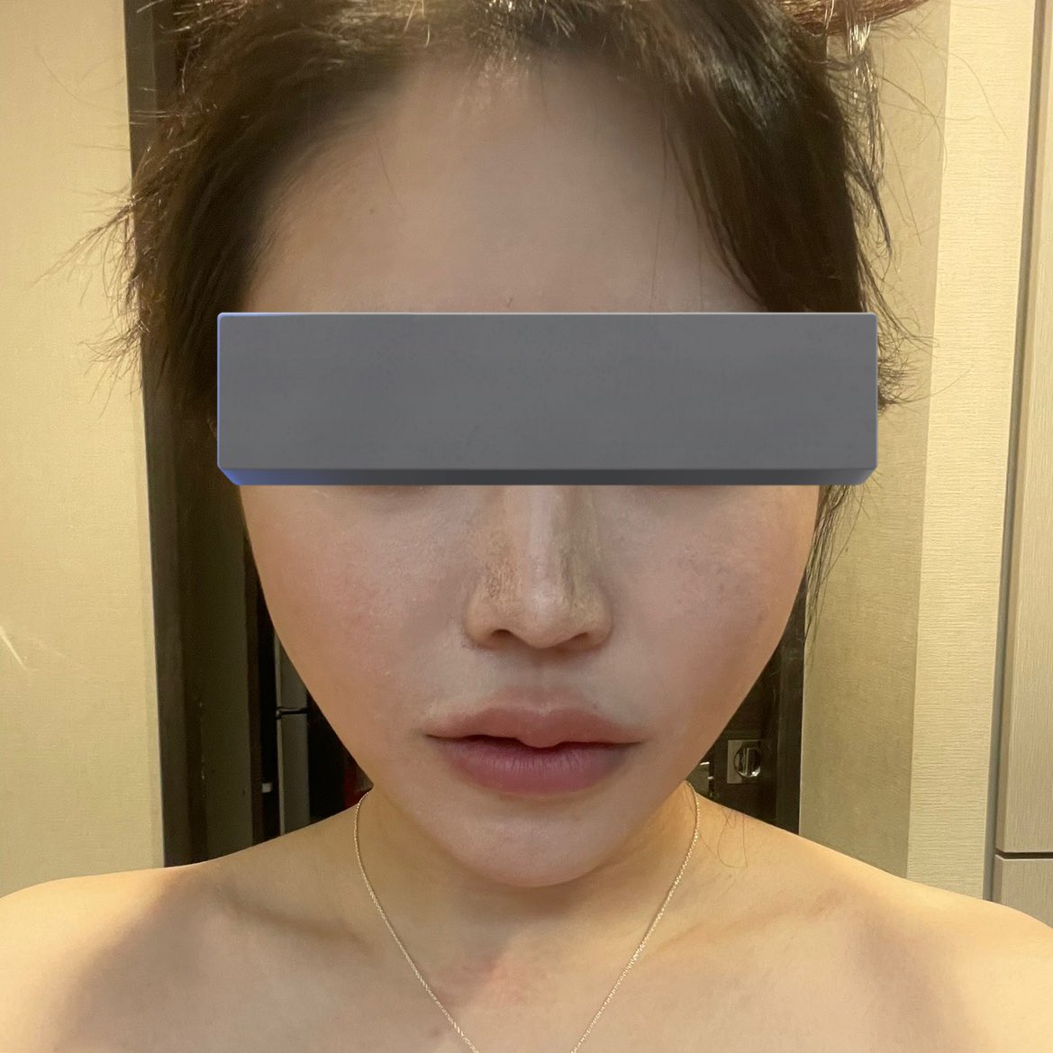 pearl_everyday's tweet photo. 1枚目元の輪郭。(脂肪吸引済み)
2枚目希望してなかったが大量に脂肪入れられた。
3枚目脂肪無くしたいがため脂肪吸引や切開リフトやレーザーやら色々してきたが元の輪郭には戻れない＆たるみも出ている。
4枚目現在。脂肪溶解注射と糸リフトもして入れられた脂肪は完全に取れたかなという感じ。でも2、3年丸々ずっと修正に費やしてきて25歳からの貴重な若い時間を失ったし、出会いも全て諦めてきた。悔しくなるから掛かった莫大な費用とかもう考えないようにしてるけど、たまに元の写真見て
何かが全然違う、って。2年で結構老けたのか、手術を繰り返しまくったから血流も悪くなってそのせいで肌の透明感も違うし、
ストレスで円形脱毛症にもなったり、誰にも会えないし、かなりしんどかったな。本当に私の人生を狂わせたル〇だけは一生許さん。
