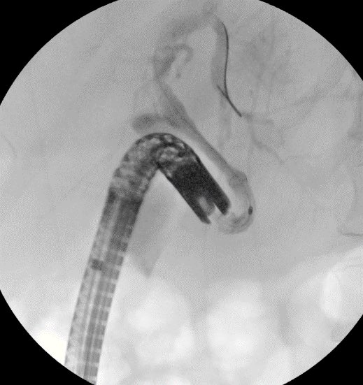 Failed ERCP due to acute angulation of papilla from pancreatic mass. We performed EUS guided RV ERCP as there were minimal dilation of the CBD. 19G <a href="/bostonsci/">Boston Scientific</a> FNA needle followed by .025 wire passage is our preferred approach for biliary access in these cases. #GITwitter